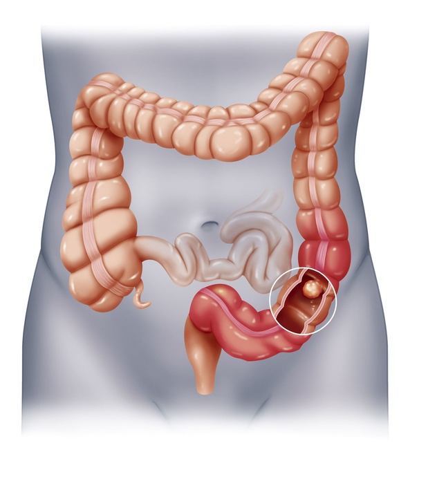 Slechts een op zes Brusselaars laten zich testen op darmkanker